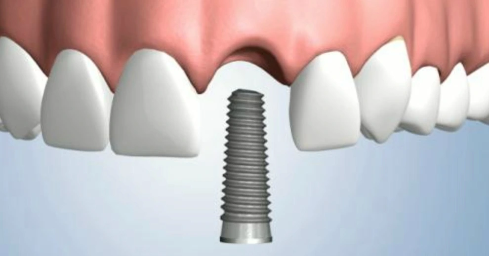 Best dental implants 