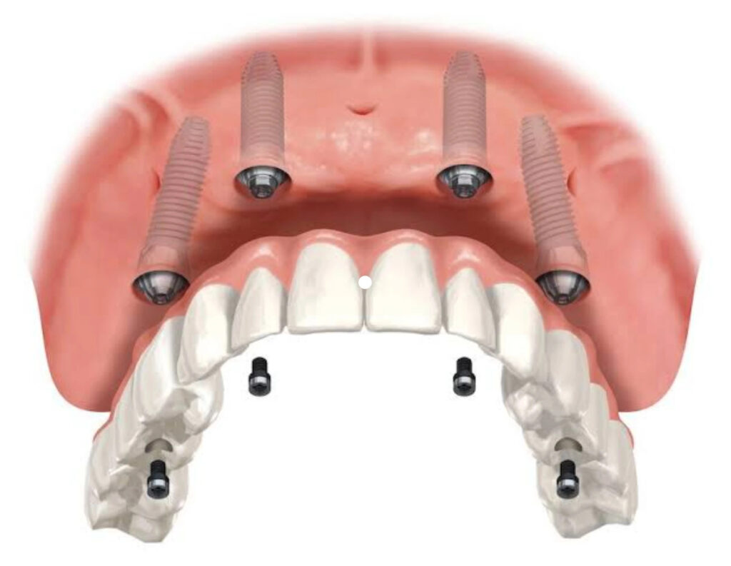 Best dental implants