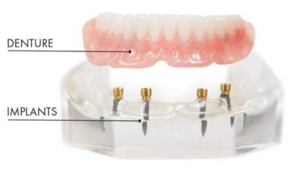 Best dental implants 