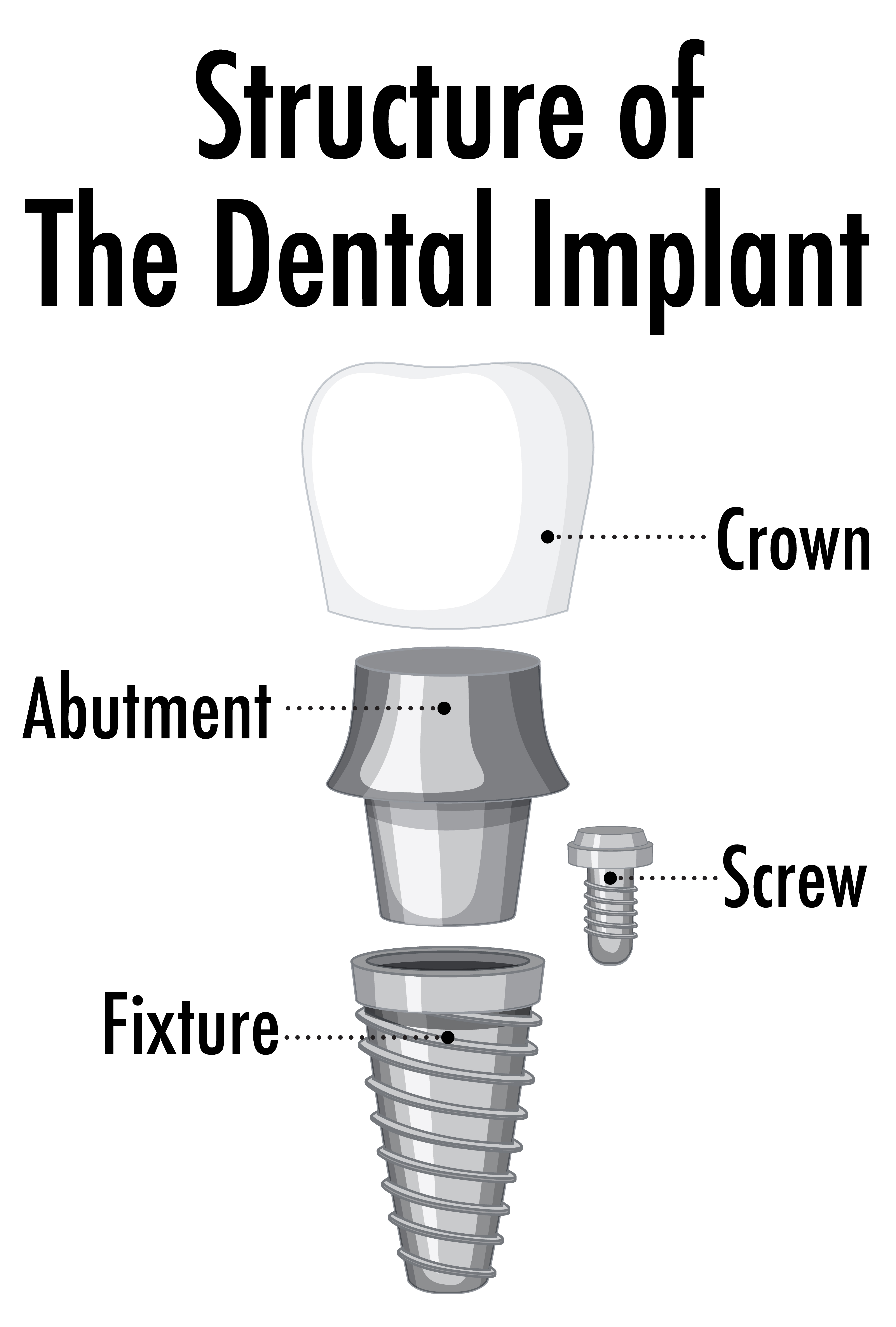 Diagram showing the structure of a dental implant including crown, abutment, and titanium implant used in dental treatments in Los Algodones, Mexico