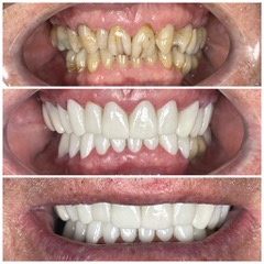 Before and after zirconia crowns full smile restoration in Los Algodones Mexico